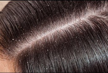 What to Do If You Have A Scalp Condition   