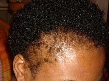 What are Your Best Options if You Have Alopecia?